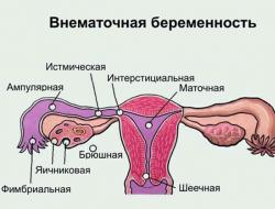 Перевязка фаллопиевых труб – опасна ли процедура Перетягивание труб у женщин